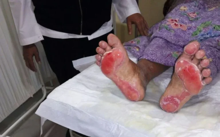 Telapak kaki pasien dengan luka bakar parah dan lepuh kemerahan sedang diperiksa.